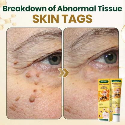 Alcuras® Wart Remover Cream with Bee Venom and Salicylic Acid – Skin Tag Removal & Skin Repair Formula for Face and Body