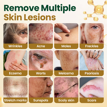 Alcuras® Wart Remover Cream with Bee Venom and Salicylic Acid – Skin Tag Removal & Skin Repair Formula for Face and Body